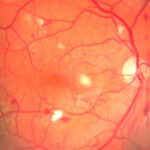 Diabetis im Auge