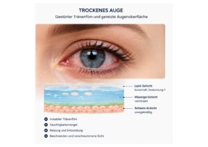 so sehen trockene Augen aus