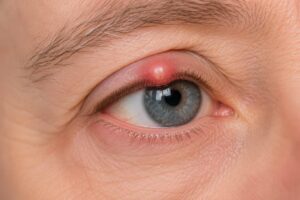 Hagelkorn Augenlider linkes auge